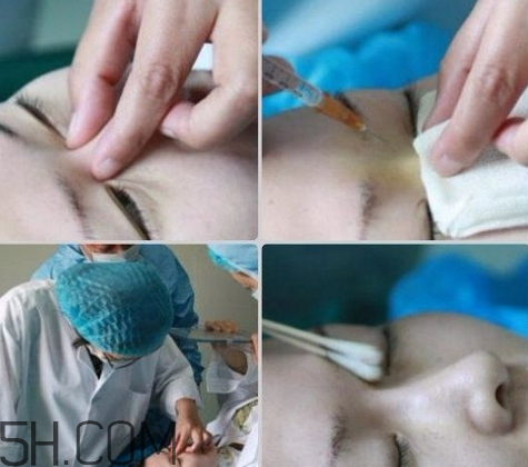 玻尿酸多少錢一支？打玻尿酸有危害嗎？