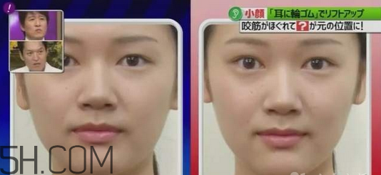 打瘦臉針的前后注意事項 臉胖的原因有哪些 打瘦臉針的前后注意事項 臉胖的原因有哪些