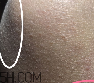 水楊酸可以去黑頭嗎？水楊酸可以去閉口嗎