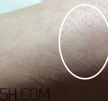 水楊酸可以去黑頭嗎？水楊酸可以去閉口嗎