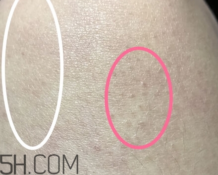 水楊酸可以去黑頭嗎？水楊酸可以去閉口嗎