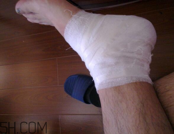 運(yùn)動(dòng)損傷是怎么造成的？怎么預(yù)防出現(xiàn)運(yùn)動(dòng)損傷？