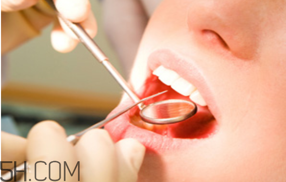 洗牙出血是正常嗎？洗牙后多久可以吃東西？