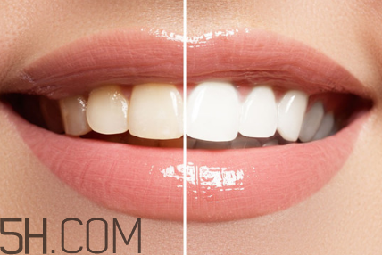 牙齒內(nèi)側(cè)的黃垢怎么去除？每天刷幾次牙齒最合適？