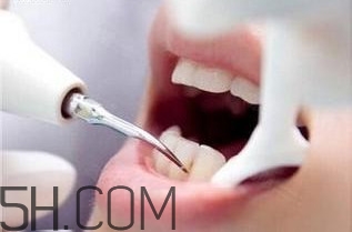 洗牙對(duì)牙齒好嗎？洗牙的6大誤區(qū)