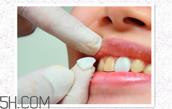 超聲波洗牙可以美白牙齒嗎？超聲波洗牙多少錢一次？