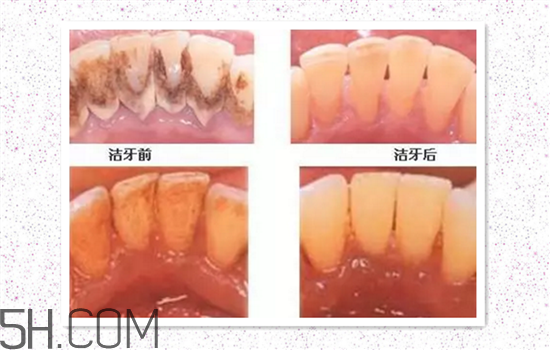 超聲波洗牙可以美白牙齒嗎？超聲波洗牙多少錢一次？