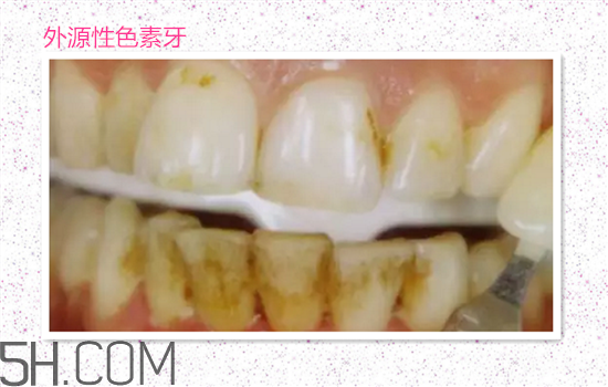 超聲波洗牙可以美白牙齒嗎？超聲波洗牙多少錢一次？