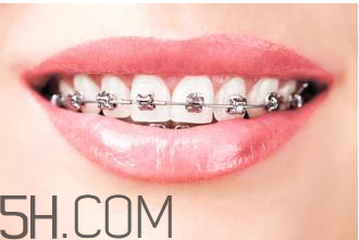 補牙需要帶牙套嗎？補牙后要裝牙套多少錢？