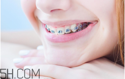 牙套的作用 牙套要戴多久 牙套的作用 牙套要戴多久