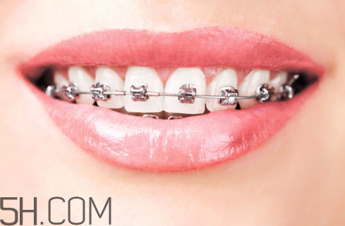 戴牙套可以懷孕嗎？牙齒矯正的后遺癥
