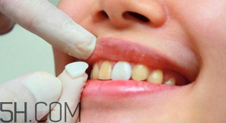 烤瓷牙取下來還能用嗎？瓷貼面美白對牙齒有損害嗎？