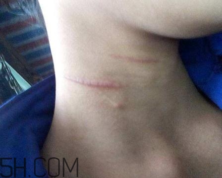 密麗除疤膏怎么用？密麗除疤膏什么時候用？