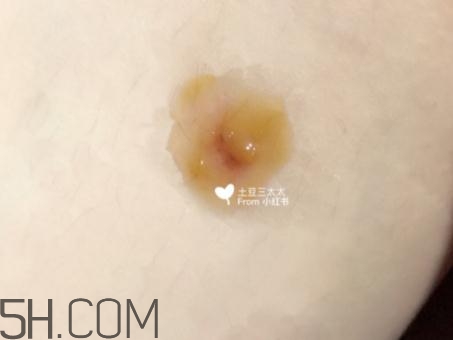 美寶濕潤燒傷膏怎么樣？美寶濕潤燒傷膏有用嗎？