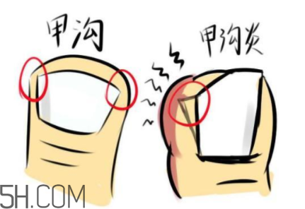 為什么容易得甲溝炎？怎么根治甲溝炎？