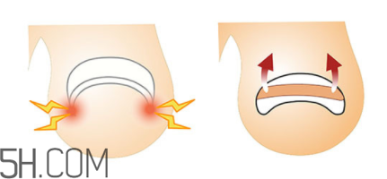 為什么容易得甲溝炎？怎么根治甲溝炎？
