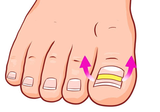 為什么容易得甲溝炎？怎么根治甲溝炎？