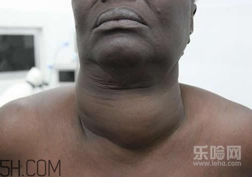 甲狀腺腫大和甲亢的區(qū)別有哪些？甲狀腺腫大適合吃什么食物？