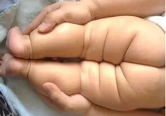寶寶腿紋不對稱是怎么回事？嬰幼兒的生長發(fā)育標準是怎樣的？