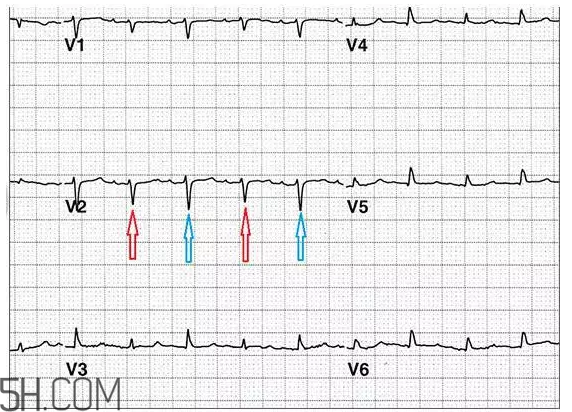 心電圖怎么看？6種常見心電圖異常情況