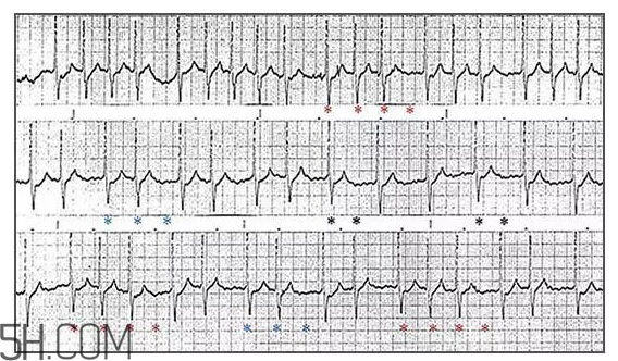 心電圖怎么看？6種常見心電圖異常情況