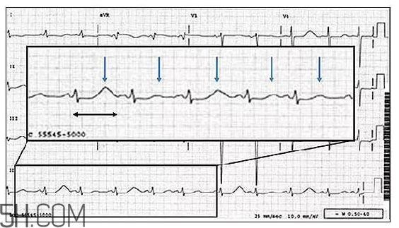 心電圖怎么看？6種常見心電圖異常情況