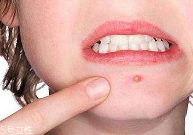 下巴起痘怎么辦？超好用祛痘辦法分享