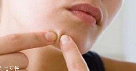 下巴起痘怎么辦？超好用祛痘辦法分享