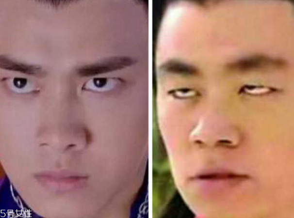 死魚(yú)眼怎么治？割雙眼皮可以治死魚(yú)眼