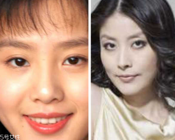 死魚(yú)眼怎么治？割雙眼皮可以治死魚(yú)眼