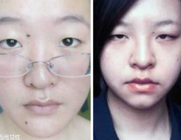 死魚(yú)眼怎么治？割雙眼皮可以治死魚(yú)眼