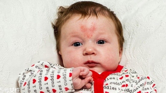 寶寶胎記會(huì)自動(dòng)消失嗎？不同胎記消失情況不同