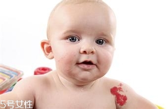 寶寶胎記會(huì)自動(dòng)消失嗎？不同胎記消失情況不同