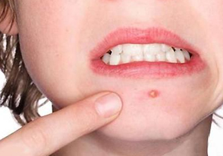 下巴起痘怎么辦？超好用祛痘辦法分享