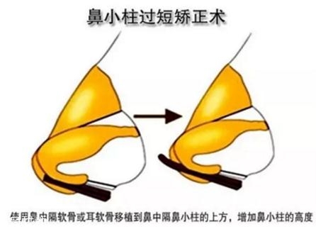 鼻小柱延長(zhǎng)用什么材料？?jī)?yōu)先選擇鼻中隔軟骨