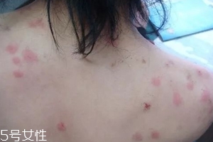 螨蟲有哪些危害？嚴(yán)重時肌膚糜爛