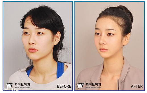 韓國人最愛整哪兒？韓國整形部位TOP4