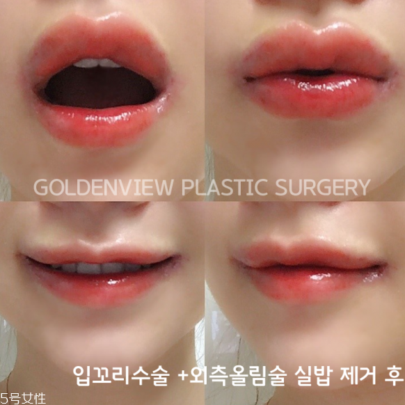 韓國人最愛整哪兒？韓國整形部位TOP4