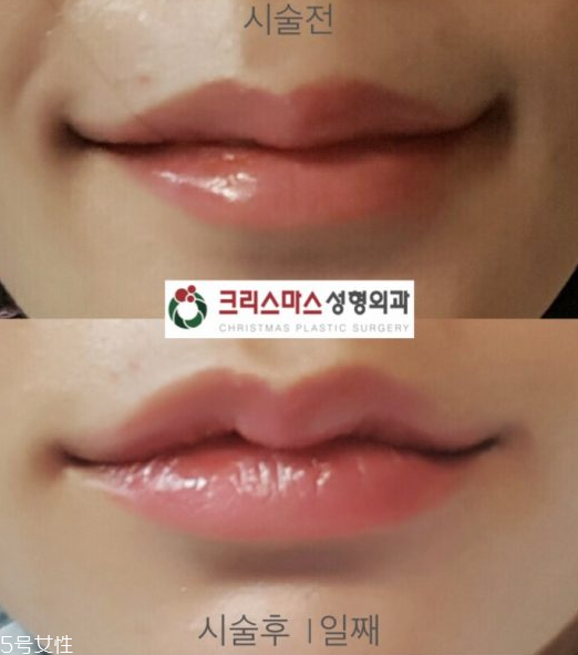 韓國人最愛整哪兒？韓國整形部位TOP4