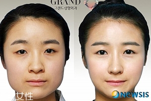 韓國人最愛整哪兒？韓國整形部位TOP4