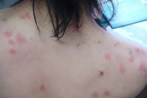 螨蟲(chóng)有哪些危害？嚴(yán)重時(shí)肌膚糜爛