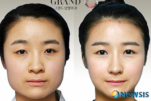 韓國(guó)人最?lèi)?ài)整哪兒？韓國(guó)整形部位TOP4