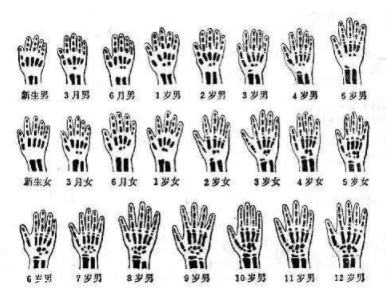 哪些人需要測(cè)骨齡？長(zhǎng)太快警惕骨齡提前