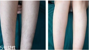 激光脫毛有哪些原理？激光脫毛后護(hù)理小貼士