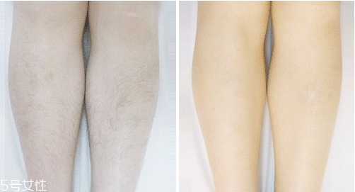 激光脫毛手術后怎么護理？激光脫毛一定要做好防曬