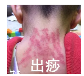 吮痧有什么療效？最溫柔的治病方法