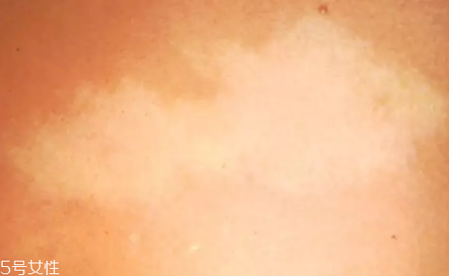 痣什么情況下會(huì)轉(zhuǎn)變?yōu)榱觯奎c(diǎn)痣不可取