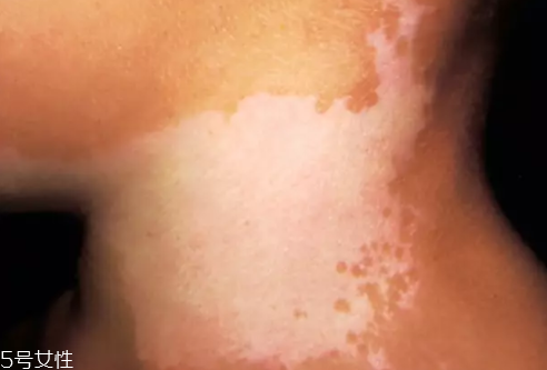 痣什么情況下會(huì)轉(zhuǎn)變?yōu)榱?？點(diǎn)痣不可取