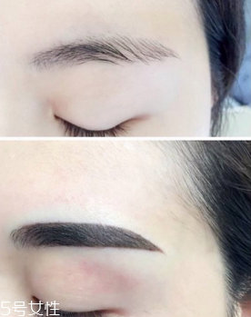 激光洗眉恢復期有疤痕怎么辦？激光洗眉毛之后正確護理方法