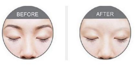 激光洗眉恢復期有疤痕怎么辦？激光洗眉毛之后正確護理方法